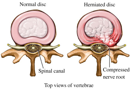 herniated disc symptoms herniated disc pain
