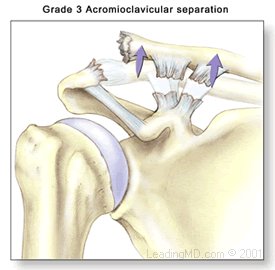 AC Separation