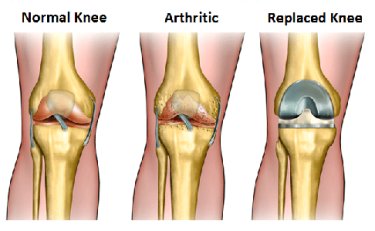 knee replacement surgery