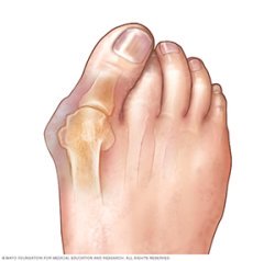 bunion pain bunion surgery