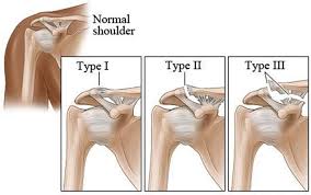 shoulder injury ac separation