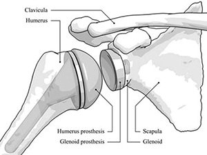 shoulder surgery shoulder replacement