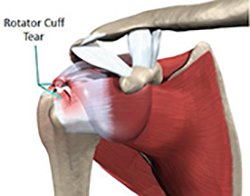 shoulder surgery rotator cuff tear