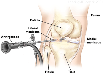 What is the recovery time for a minor meniscus tear surgery?