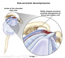 Rotator Cuff Injuries: Tears, Impingement, and Tendonitis
