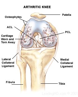 Arthritic Knee