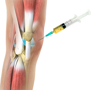 Stem Cell Therapy and PRP Injections - The Steadman Clinic