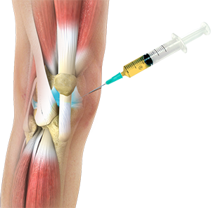 Prp Injection Knee, Prp, Stem Cells - Revive Spine and Pain Care